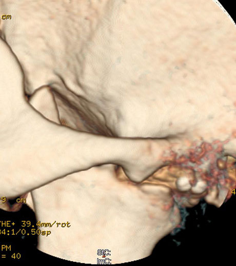 Fig 3. Langtkommen bilateral destruksjon av caput mandibula med fast ankylose hos mann med Bekhterevs sykdom, vellykket behandlet med bilateral totalprotese.